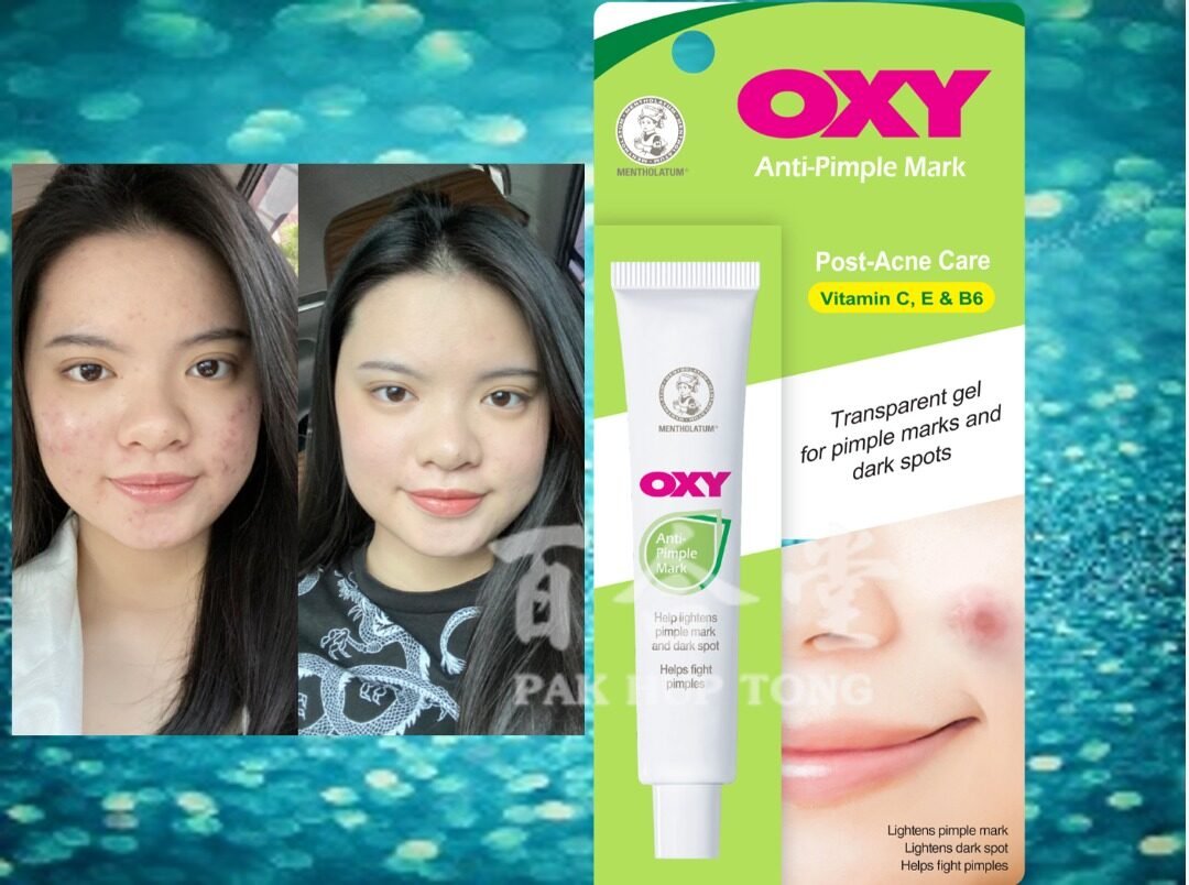 Acne Products
