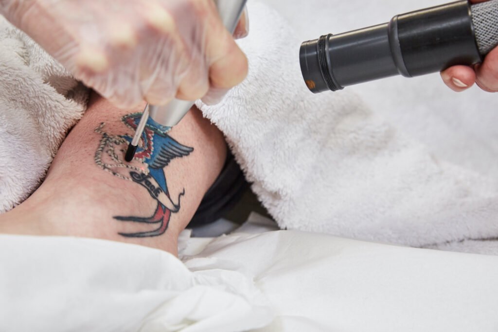 Laser Tattoo Removal: Say Goodbye to Regret and Hello to Fresh Skin!