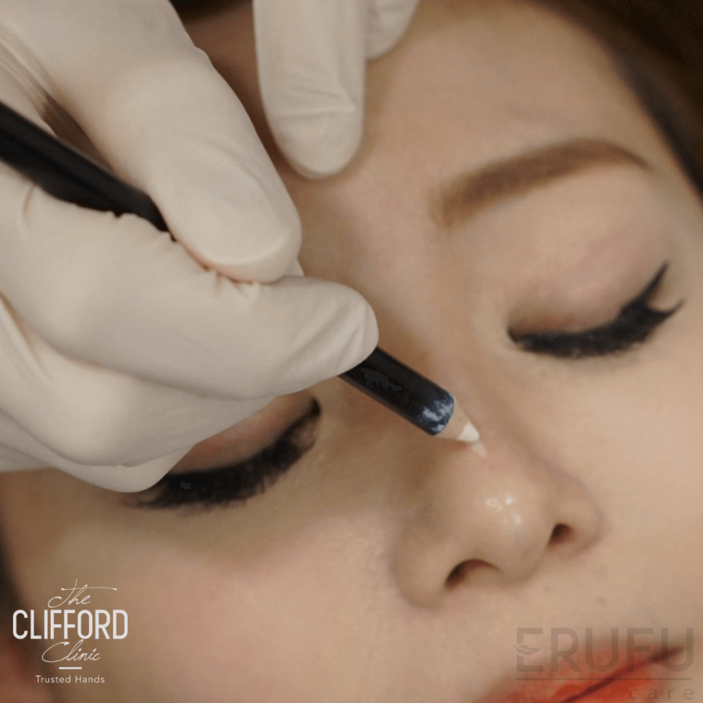 Double Eyelid Stitching