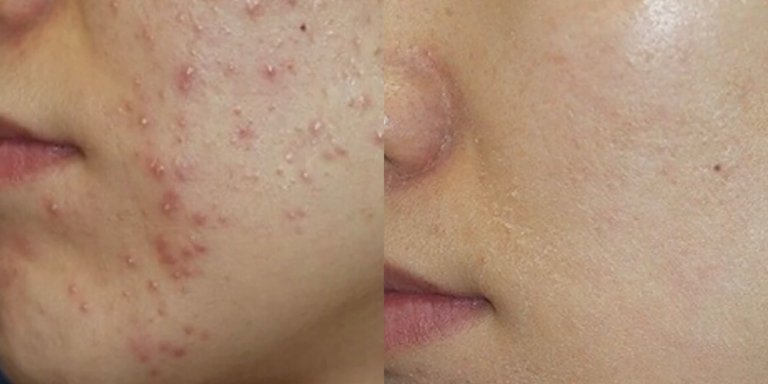 laser acne mark removal