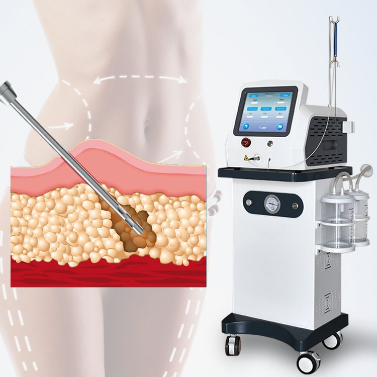 Laser Lipolysis