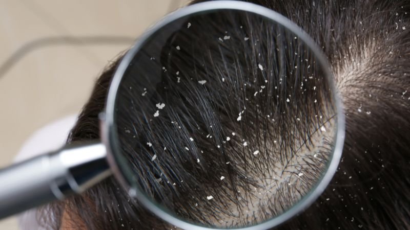 How to care for scalp