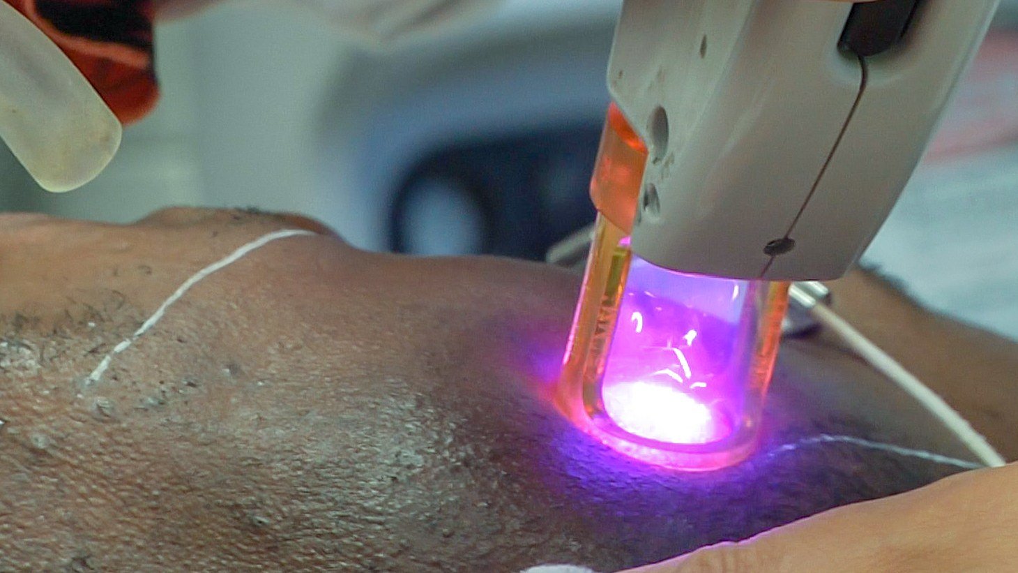 A laser hair removal handpiece emitting a bright purple-pink light being applied to dark skin, with a white cord attached, during a clinical treatment session
